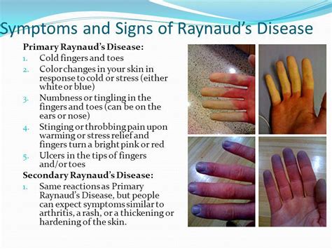 raynaud's disease symptoms and treatment.